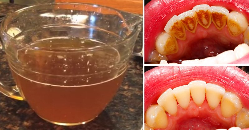 study-natural-tea-removes-plaque-better-commercial-mouthwash